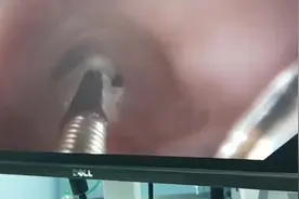 猫吃了一坨线，内窥镜顺利取出视频封面