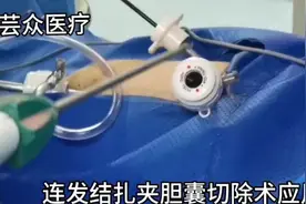 #胆囊切除术#连发接扎夹#医疗器械 #抖音小助手 #芸众医疗视频封面