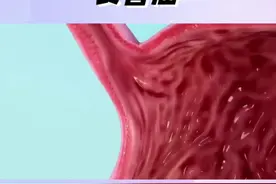 世界癌症组织将超过65度热食列为2A类致癌物＊ #烫食 #2a类致癌物 #食管癌 #胃癌 #董剑宏胃癌工作室视频封面