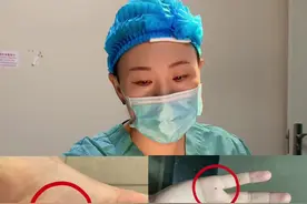 手心脚底的痣到底需要切除吗？看完这条视频你就知道了！#色素痣 #脚上的痣必须去掉吗 #医学科普视频封面