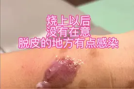 烧伤以后，争取的处理是关键#外科医生 #烧伤 #烫伤视频封面