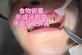 食物嵌塞，牙龈反复肿胀，牙槽骨吸收，牙周袋形成#牙周炎视频封面