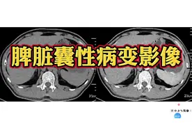 脾脏囊性淋巴管瘤CT影像，注意和单纯囊肿鉴别！ #影像视频封面