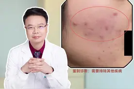 为什么长痘吃多西环素、米诺环素吃了有效停了复发？#皮肤科医生谢红付  #红付教授说敏痘  #痤疮  #痘痘  #手把手让你更健康  @谢红付聊敏痘视频封面