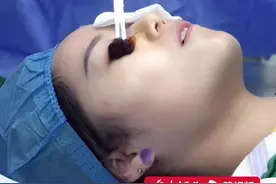 因近视手术中医生激光打偏，20岁女子角膜受损 患严重干眼症，“只能用自己血做成的眼药水缓解不适”，提醒大家做飞秒手术前一定要慎重 （来源：@67846029301 ）视频封面