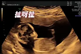 好聪明的宝贝！脐带绕颈就这样被拿开啦~#脐带绕颈 #婴儿 #记录