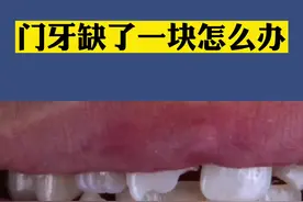 门牙缺了一小块怎么办？#补牙 #武汉口腔医生孙明宇