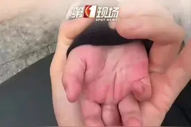 近日，广东深圳，1岁幼童在自家奶茶店被切断3根手指，原因竟然是一台封口机.....#封口机 #断指再植 #幼童被封口机切断手指 #深圳dou知道 @抖音短视频视频封面