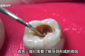 牙洞不补，会越来越大吗？？#爱牙护牙 #龋齿已经烂空了怎么办视频封面