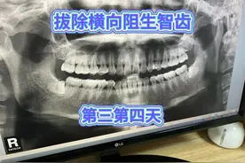 拔除横向阻生智齿第三第四天，听我的，拔牙开刀一定要去打消炎针