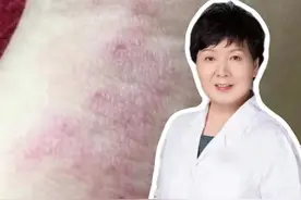 湿疹总不好怎么回事？#湿疹视频封面