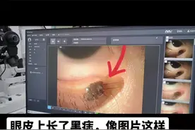 #医学科普 #眼睛 #黑痣 #徐医附院眼科王贺视频封面
