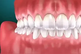 智齿是怎么拔的?为什么建议拔除呢?快来看看拔除过程吧！ #口腔科普 #一口好牙 #牙齿 #智齿 #拔牙视频封面