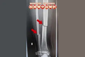 胫骨看是对位对线良好，实际上骨折远端是旋转移位的。#骨折#手法复位#正骨#胫腓骨骨折#中医