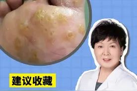 脚上长了跖疣，教你在家处理！#兔年开工健康指南 #跖疣 #跖疣到底该怎么治 #健康科普 #医学科普 #健康 #知识分享 #越早知道越好 #科普