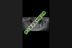 利用停止曲配合牵引钩可以很好的控制6-6的所有间隙 #正畸 #牙齿矫正 #整牙历程 #口腔 #牙套日记视频封面