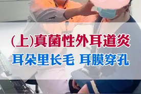 真菌性外耳道炎，耳朵里面长毛，耳膜穿孔怎么治疗？#真菌性外耳道炎 #中耳炎  #真菌感染 #耳膜穿孔 #耳鼻喉刘军