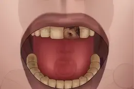 拔出蛀牙补牙小流程，各位朋友们请观摩~#刷牙 #补牙