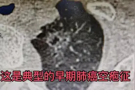 典型的早期肺癌空泡征#肺结节 #中医 #中医养生 #医生视频封面
