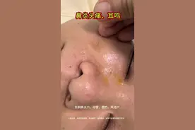 鼻炎头痛 鼻炎，头痛，还耳鸣，互相影响，睡眠也不好#中医针灸 #鼻炎 #耳鸣 #头痛 #鼻炎穴