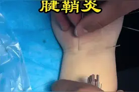 得了腱鞘炎，手指屈伸疼痛怎么办？ #腱鞘炎 #手腕疼 #针灸调理 #曹方针灸工作室