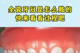 全瓷牙冠是怎么戴的?快来看看过程吧！ #牙齿🦷 #口腔科普 #全瓷牙冠 #一口好牙