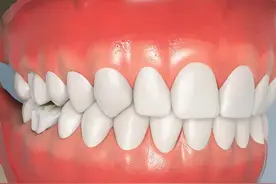全瓷牙冠是怎么戴的?快来看看过程吧！ #牙齿🦷 #口腔科普 #全瓷牙冠 #一口好牙