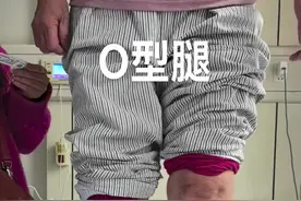 老年O型腿如何处理？#o型腿 #罗圈腿 #o型腿矫正 #膝关节 #膝关节疼痛视频封面