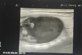 患者，女性，因左侧颈部疼痛3天来诊，有甲状腺结节病史多年。