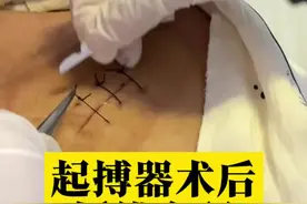 #起搏器 术后8天拆线全程#心内科 #医生 #医学科普 #心脏视频封面