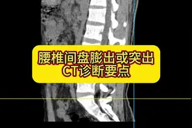 5分钟教会你如何在CT上诊断椎间盘膨出或突出#椎间盘突出视频封面