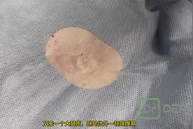 大脓包#挤痘痘 #重口味 #引人不适请谨慎观看 #视觉冲击 #解压视频封面