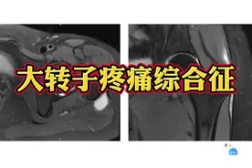 髋关节大转子疼痛综合征影像表现分享，简单易懂！