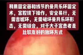 利用线节和固定器的曼月乐环固定术，宫腔镜下操作，安全易行，无需吉妮环，破坏曼月乐环形态，无需缝合，对于大子宫患者是比较友好的防止脱落的放环方式。视频封面