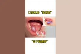 舌下腺囊肿，您了解吗？ #舌下腺囊肿 #硬核健康科普行动 #守护血糖健康指南