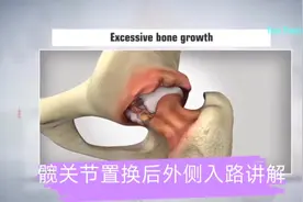 后外侧入路髋关节置换最详细讲解#医学科普视频封面