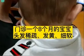 宝贝#头发稀疏发黄，要注意是否是遗传的，也可能是因为某种微量元素的缺乏所致，应该来门诊检查 #掉头发 #育儿视频封面