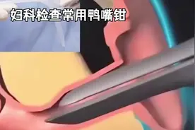 妇科检查常用鸭嘴钳#妇科小知识
