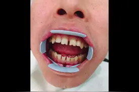 门牙缝大，也可以树脂充填关缝～#牙医日常