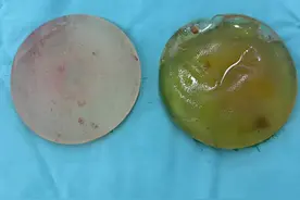 胸部假体取出#隆胸#假体视频封面