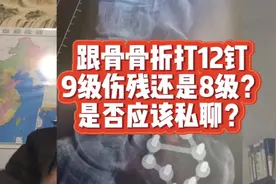 脚跟骨骨折，打了12个钉，是9级伤残还是8级？可以私了赔偿吗？