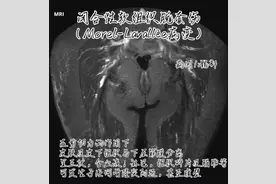 闭合性软组织脱套伤（Morel-Lavallée病变） #医学影像 #磁共振 #剪切伤 #软组织损伤 #脱套伤视频封面