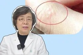 手指上长特别痒的小水疱，医生教你这样处理#医学科普 #皮肤 #健康 #汗疱疹视频封面