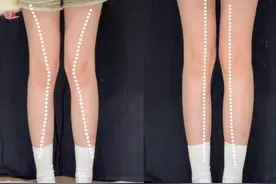 道理我都懂…但是人一旦穿了洞洞鞋 这辈子就定型了 #洞洞鞋 #足弓塌陷 #腿型 #膝盖内扣