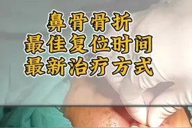 鼻骨骨折复位—最佳时间/最新治疗手段#骨折 #鼻骨骨折 #医学科普