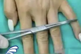 女子因美甲太厚致手指被门夹断！医生：不建议做太厚的美甲，手指末节和指甲下方是全身神经末梢分布最密集的部位之一。视频封面