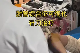 肘管综合征可视化针刀治疗 #肌骨超声诊疗一体化 #肘管综合征 #尺神经卡压 #可视化针刀#神经松解视频封面