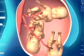 《纪录片》三胞胎是由一个受精卵分裂成三个，有着3个相同的基因视频封面