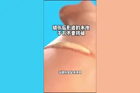 皮肤烧伤起了水泡，应该怎么办？#内容启发搜索 #涨知识 #科学探索