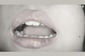 #牙齿🦷 #牙科日常 #牙齿 #拔智齿 #拔牙齿全过程 常规阻生牙拔除